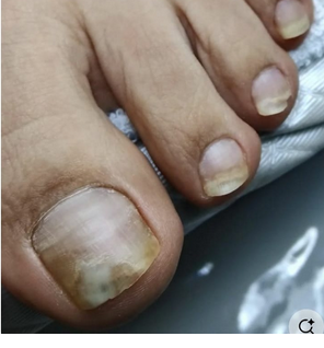 Tratamento para Micose